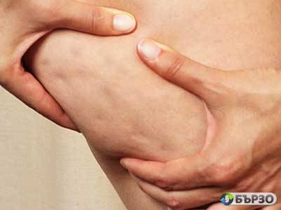 Антицелулитен масаж